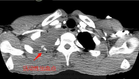 男子打个喷嚏肺泡竟然破了,小伙打个喷嚏