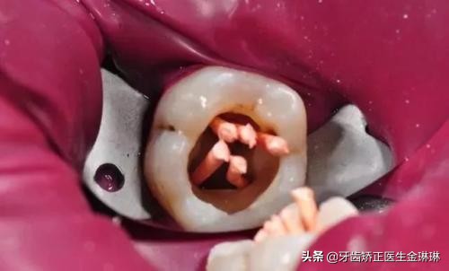 我左下连着三颗大牙没了怎么镶,孩子6岁大牙都腐蚀没了怎么办