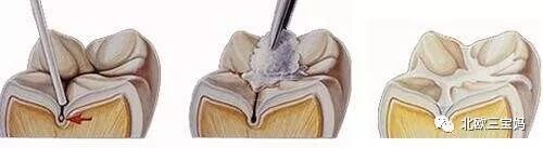 牙齿黑的地方是不是虫牙,黄牙黑牙有什么方法解决