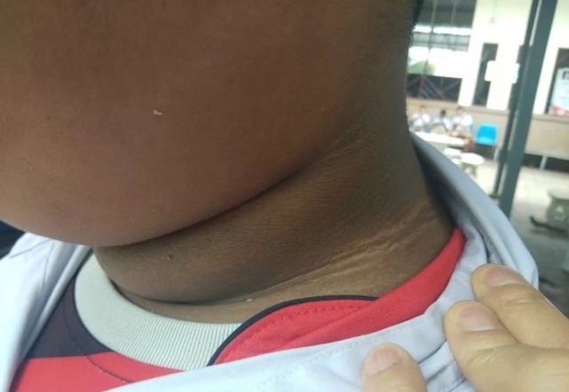 脖子旁边黑黑的洗不干净,为什么脖子上黑黑的洗不干净