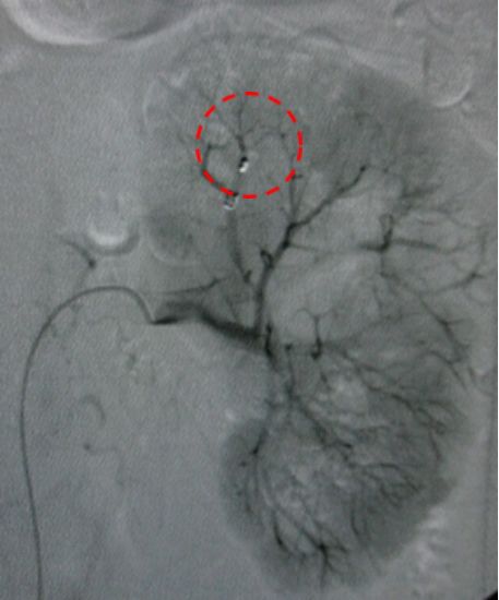 举例科普|介入能治疗哪些疾病?