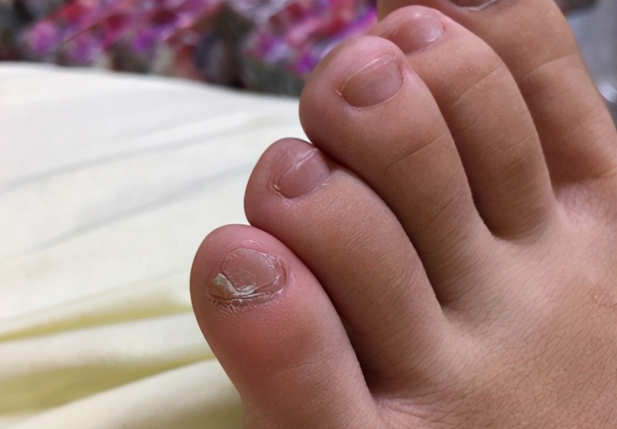 小脚趾甲两瓣的是满族还是汉族人,小脚趾甲为什么有两瓣是汉人