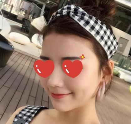 宽大又不对称脸型，被颧弓内推成功“拯救”