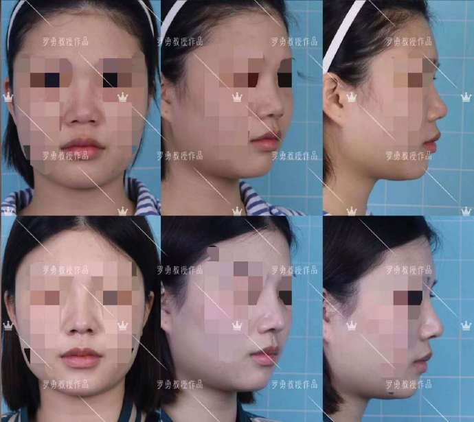 为什么不建议打眉弓针呢,为什么不建议假体隆鼻