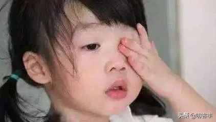 儿童过敏性结膜炎,眼睛过敏性结膜炎