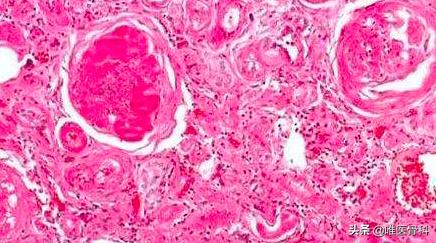 解剖第一例新冠肺炎死亡患者,第二例解剖新冠肺炎尸体