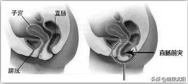 健康讲座便秘怎么治疗,大便难解的健康宣教