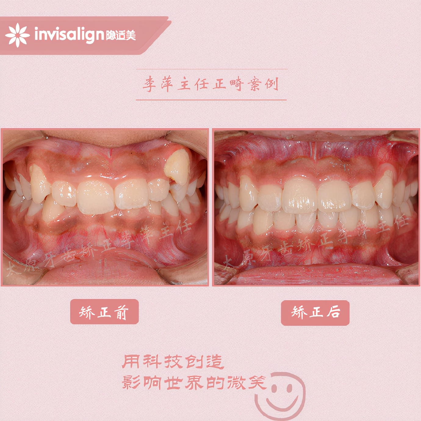 山西太原牙齿矫正医院十大排名,太原市牙齿矫正成功案