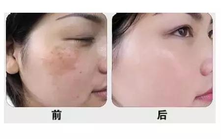 光子嫩肤和其他项目的区别,关于光子嫩肤的一些问题