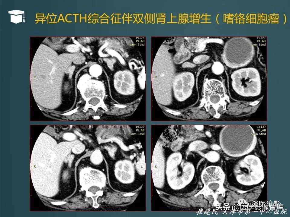 左侧肾上腺结节考虑腺瘤与增生,双侧肾上腺增生是什么原因造成的
