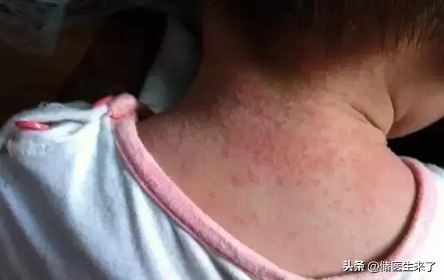 治疗儿童皮肤病的外用药,儿童皮肤病有哪些偏方