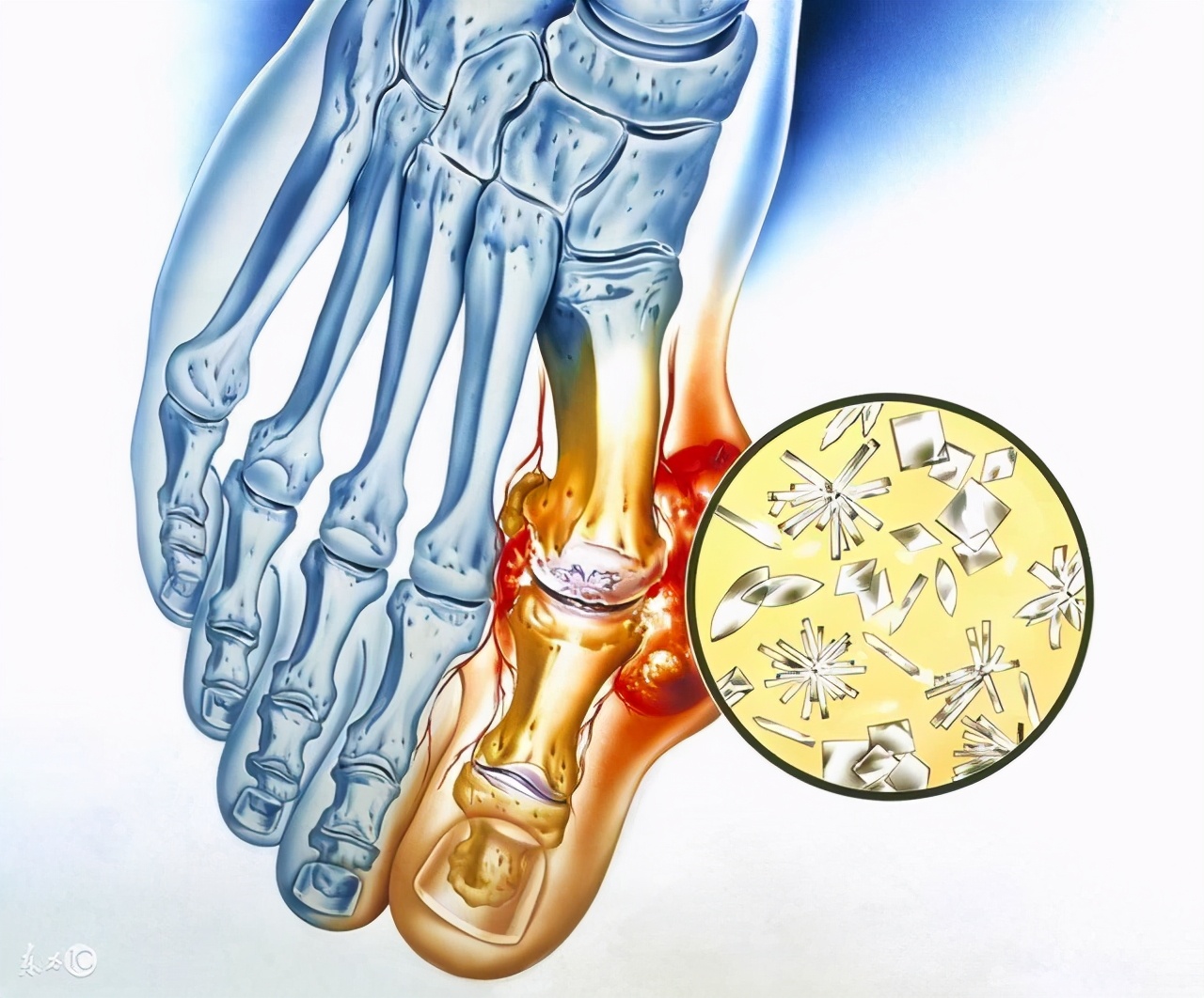 痛风石为什么会自己破,痛风石破了怎么处理