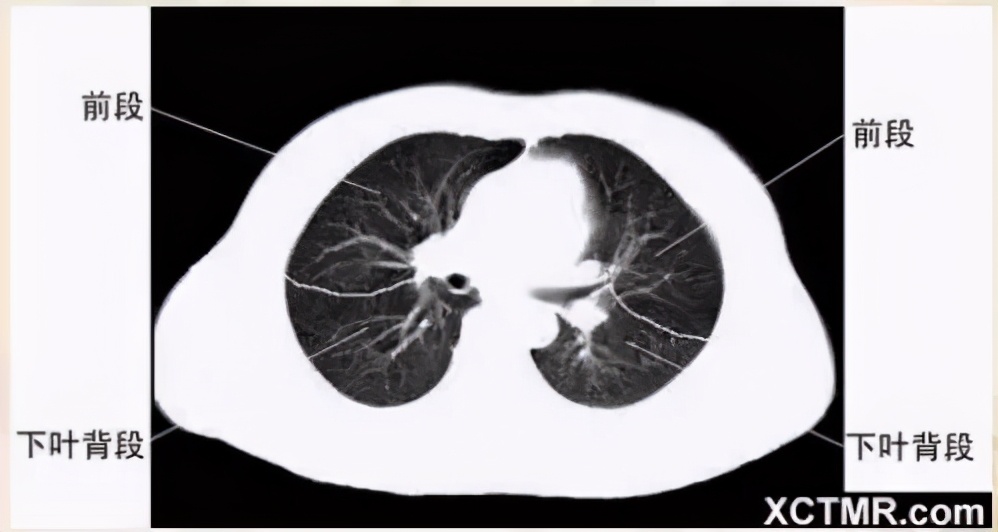 女性盆腔ct断层解剖结构图,女性盆腔脏器ct解剖