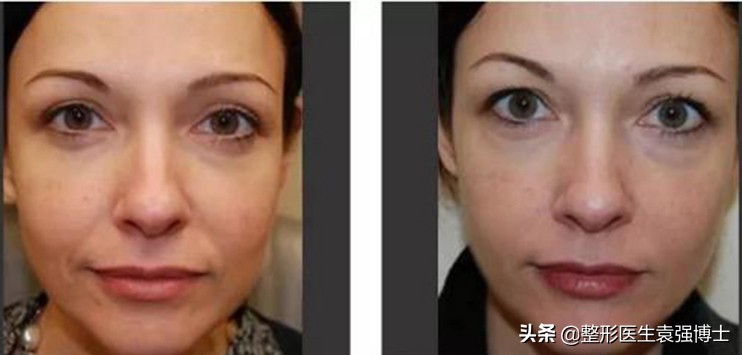 这3种方法解决法令纹效果很惊艳,最有效改善法令纹的方法