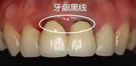 几千块补牙,几十块钱的补牙可行吗