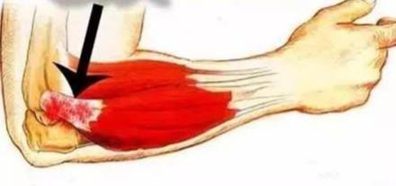 网球肘有好的治疗方法吗,网球肘有哪些治疗方法