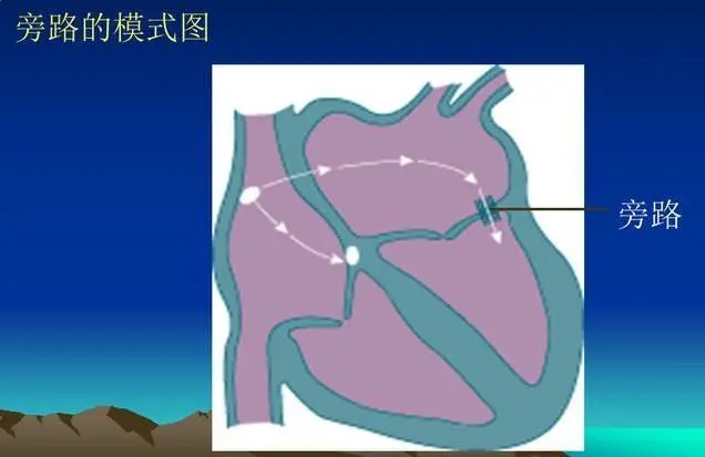 孕妇心动过速外加有点心肌缺血,怀孕心电图窦性心动过速心慌胸闷