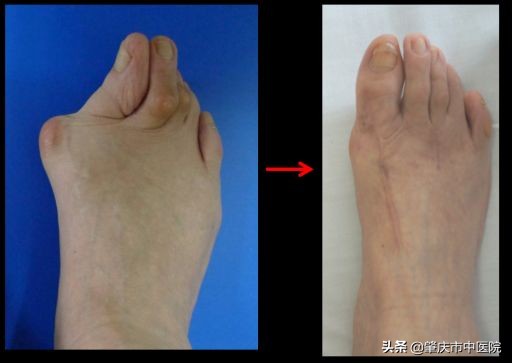 原来脚拇趾外翻是一种病，“元凶”竟是经常穿这种鞋有关！听听市中医院骨伤科专家怎么说……