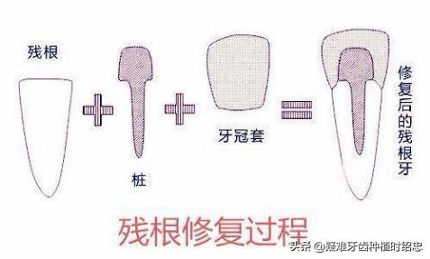 只剩残根的牙真的能补救吗,烂的只剩下黑色残根的牙怎么处理