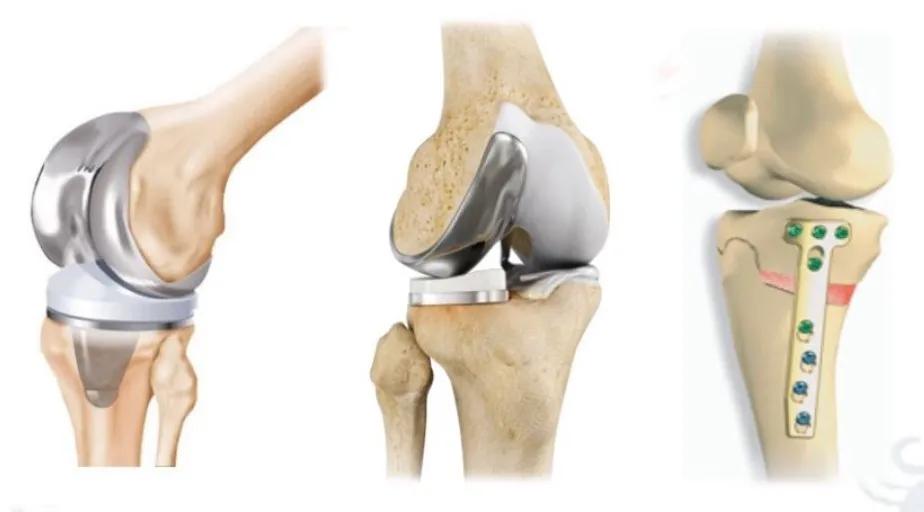 膝关节骨关节炎并内翻畸形如何选择治疗方案？