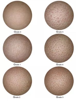 脸颊毛孔变粗有办法解救吗,脸颊器质性毛孔粗大