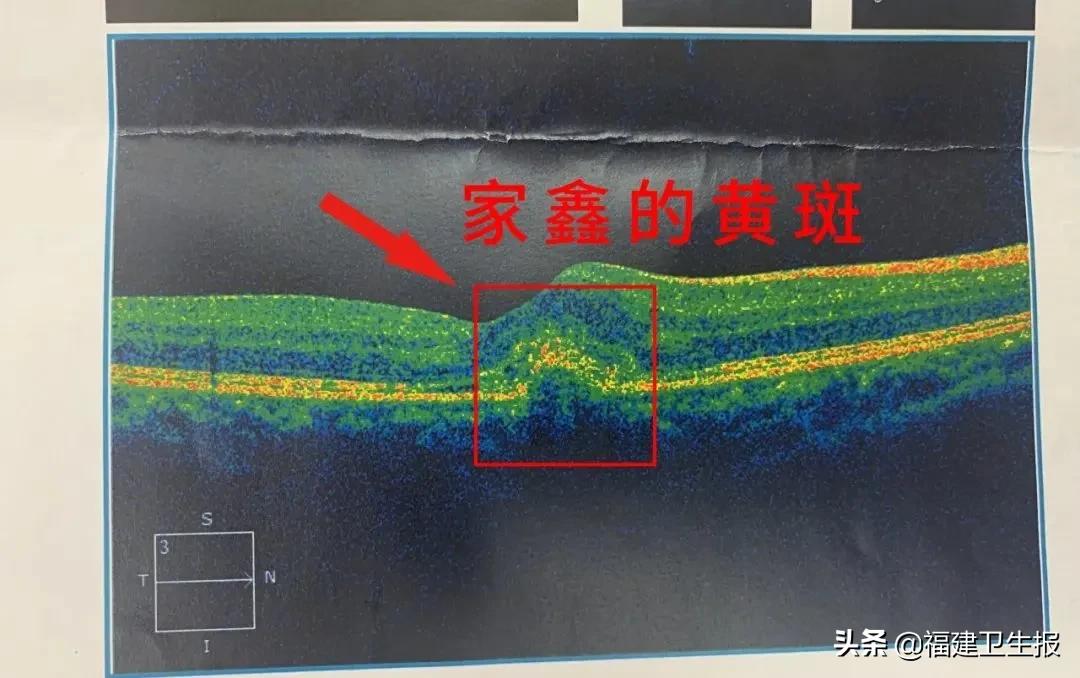 7宀佺敺瀛╁彸鐪艰鐑т激,7宀佺敺瀛╃溂鐫涜鐑т激