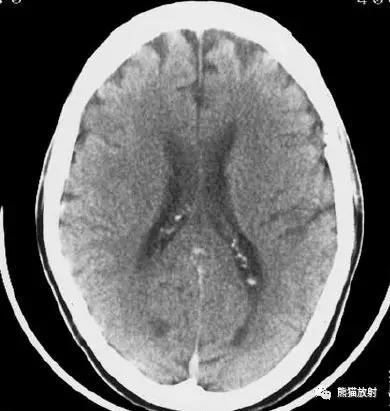 各部位脑梗死ct影像讲解,脑梗死ct影像最简单的是什么表现