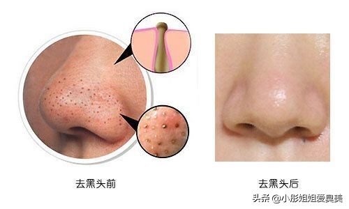 自发泡清洁黑头粉刺小气泡面膜,小气泡去黑头粉刺清洁神器好不好