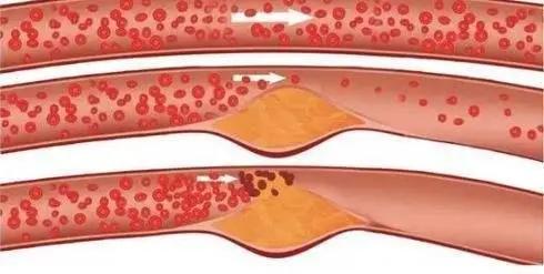 治疗血管狭窄中医有优势,治疗血管狭窄用什么药