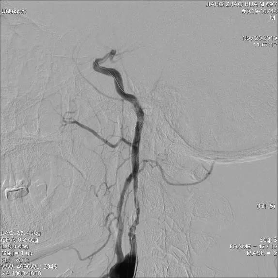 颅内覆膜支架应用于肿瘤侵袭性颈内动脉治疗