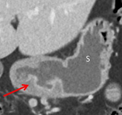 腹部ct能看出来胃的毛病吗,如果胃有问题腹部ct看得出来吗