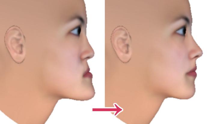 骨性龅牙怎么弄,如何判断骨性龅牙的轻重程度