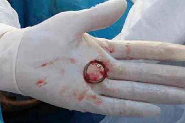 皮埋避孕和上环哪个副作用大,上环避孕的副作用