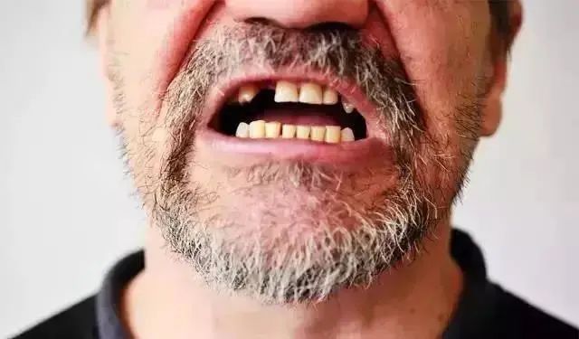 未成年缺牙不能种植牙怎么办,缺牙单色咀嚼十几年还能种植牙吗