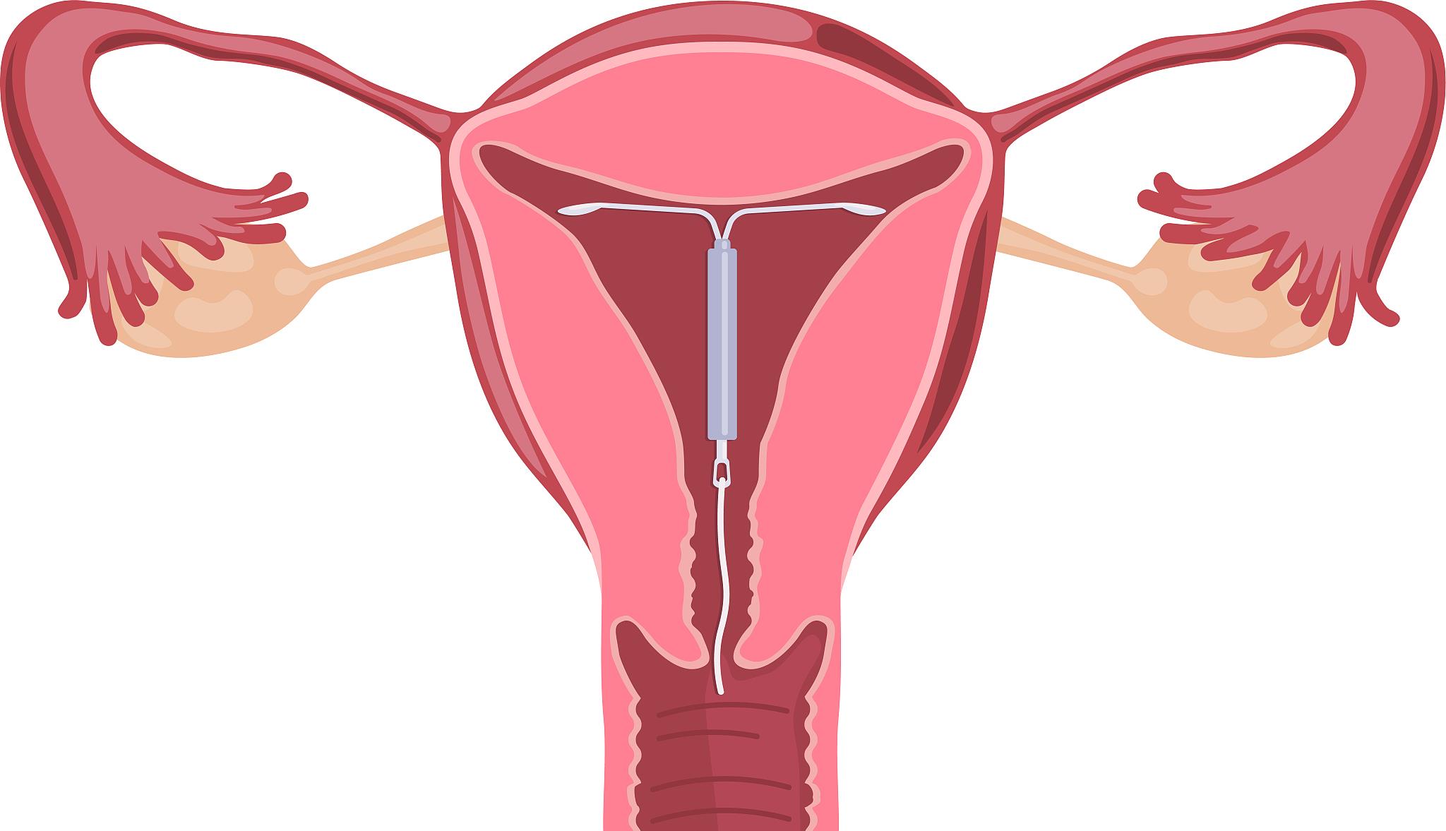 节育环必须取出吗什么时候取好,五十岁节育环取还是不取好