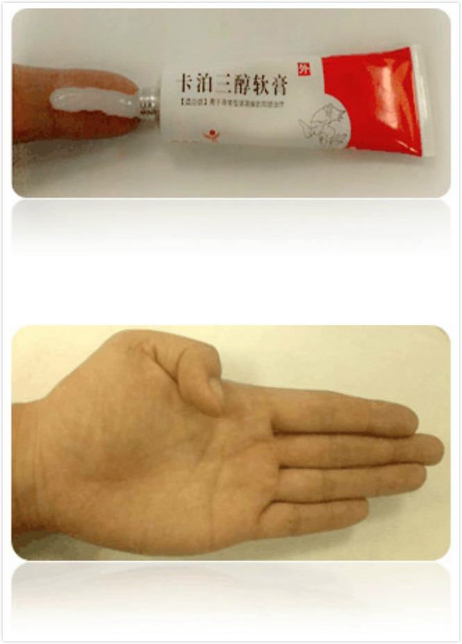 哪些情况的银屑病可以用卡泊三醇,治疗银屑病的卡泊三醇哪个最好