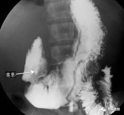 十二指肠球部溃疡解剖位置,十二指肠球部溃疡x线表现