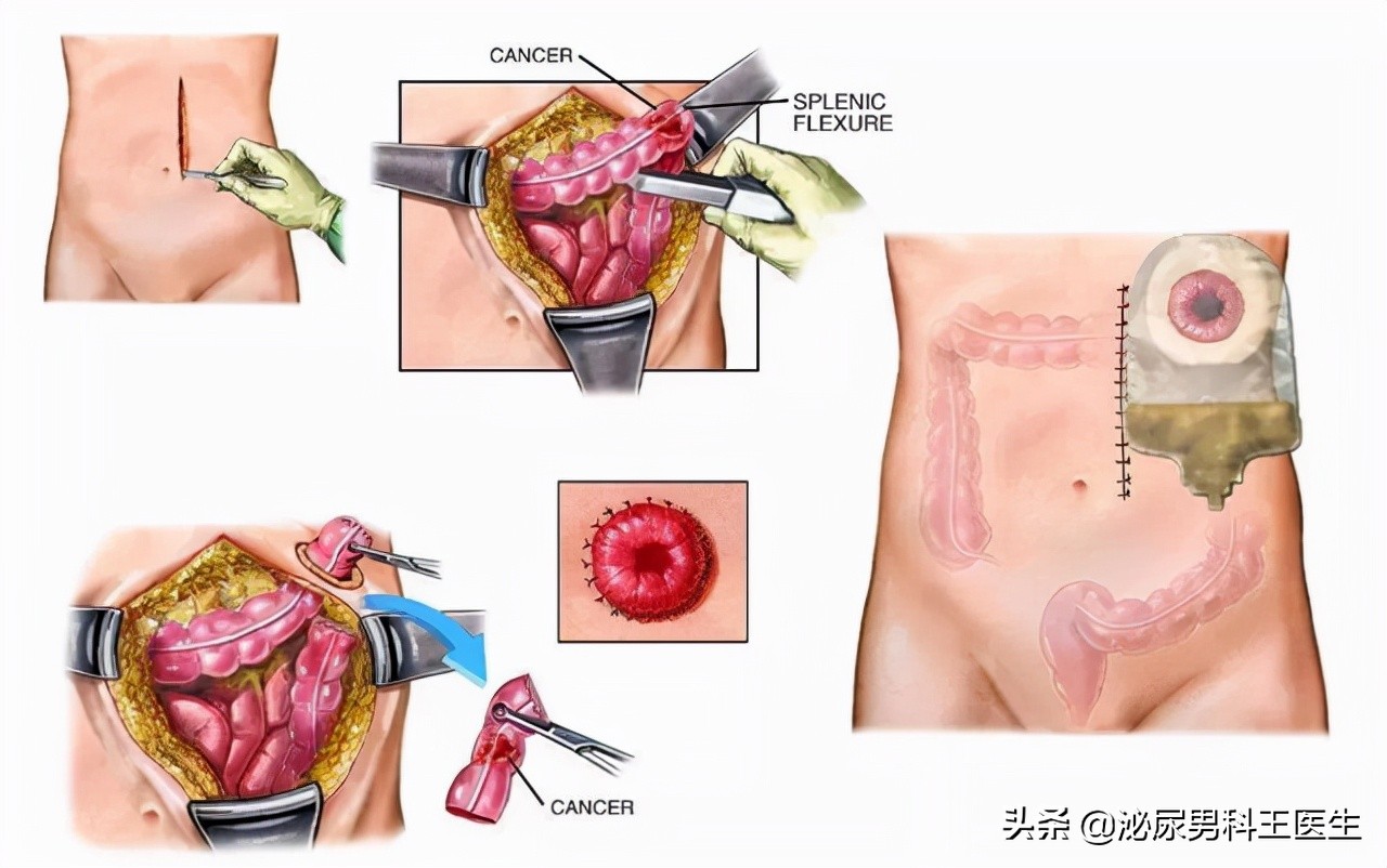 一个人没有直肠怎么办,一个人没有大肠怎么生活