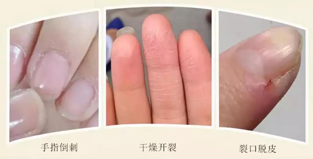 加拿大皲裂霜,加拿大修复膏