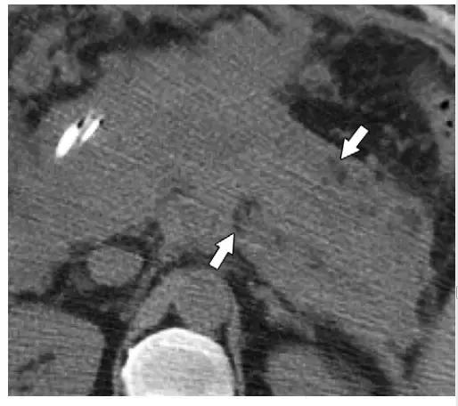 急性胰腺炎影像检查首选,急性坏死胰腺炎影像