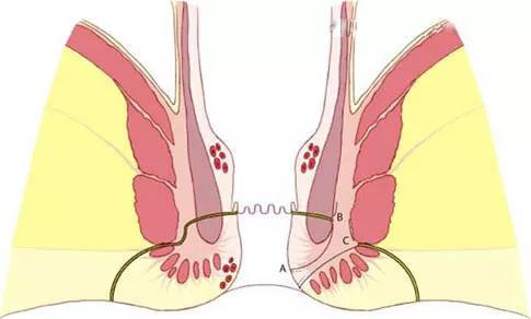 关于肛瘘,你想知道的都在这里