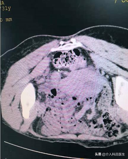卵巢巧克力囊肿穿刺最佳时间,巧克力囊肿穿刺怎么做的视频