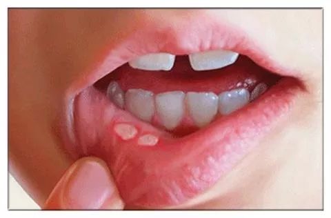 口腔溃疡反反复复体内缺什么,反反复复发作口腔溃疡怎么治疗