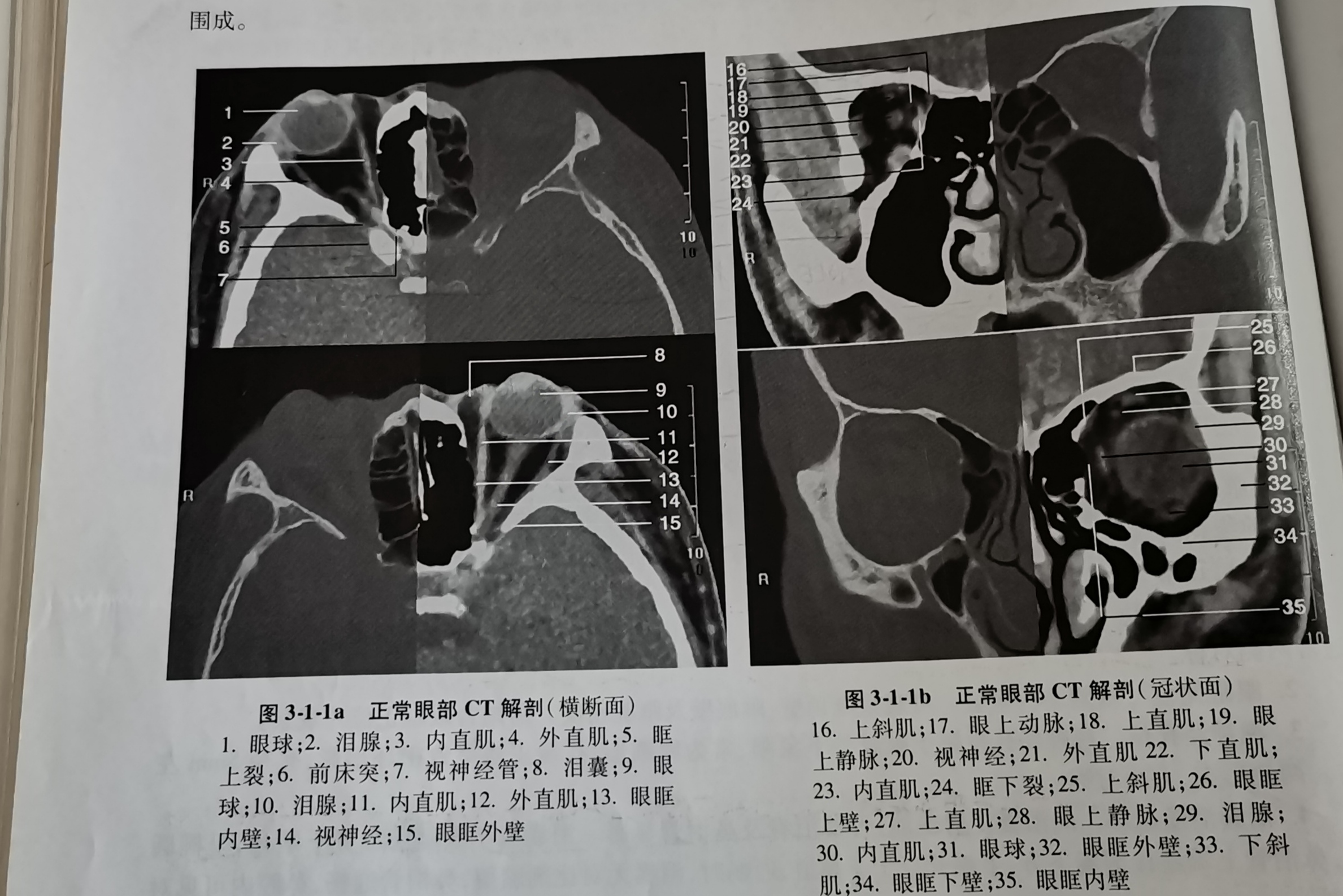 眼眶病变的常用检查方法,眼眶神经鞘瘤影像诊断