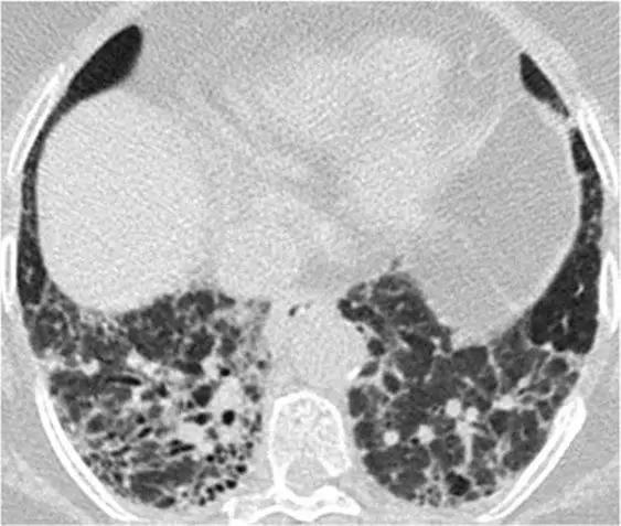 间质性肺疾病看病经验分享,分享肺腺癌临床实验的例子