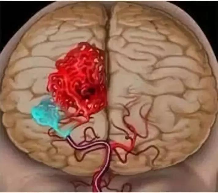 脑出血病人视频,脑出血一般寿命