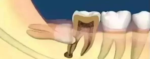 口腔智齿,智齿拔除后怎么处理智齿