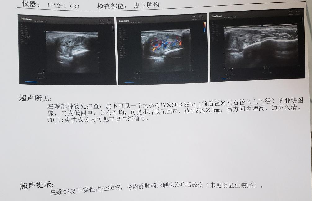 血管瘤与脉管畸形区别,血管瘤和脉管畸形有什么区别