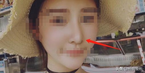 隆鼻整容老了会怎么样,隆鼻后老了