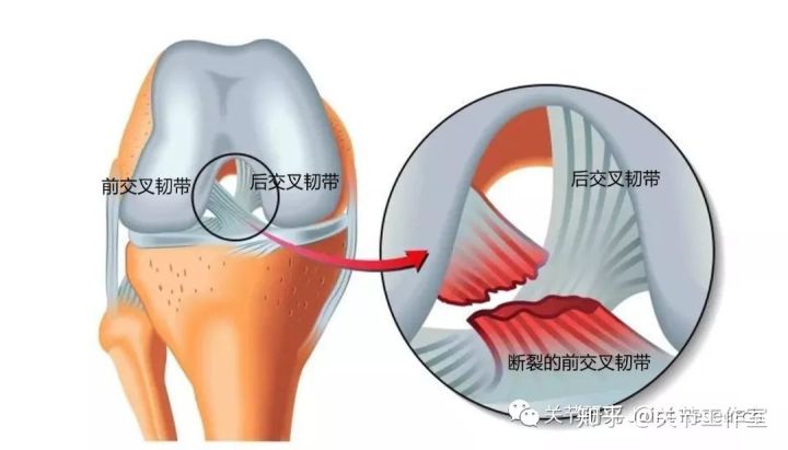 前交叉韧带断裂为什么没评上伤残,前交叉韧带断裂有什么症状